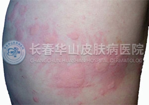 ݡ�����֢״